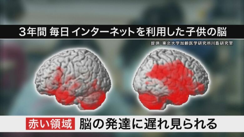 3年後に同じ子どもの左右の脳を調査した画像。「赤い部分」が脳の発達に遅れが見られたところ。色が濃いほど遅れの傾向が強いことを示している
