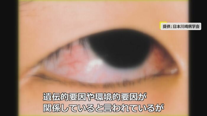 川崎病