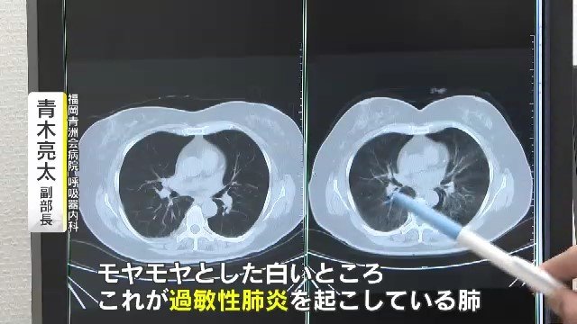 映し出された白い影が肺の病変部
