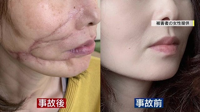 粉砕骨折に神経断裂　手術は10時間に及んだ
