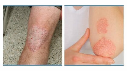 主に肘や膝などの関節付近で確認されることが多い(画像:アムジェン株式会社)