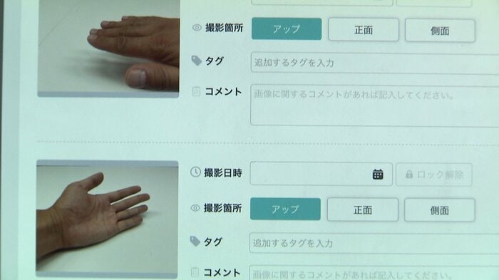 けがやあざなどの情報も安全にデータ共有が可能に(AiCAN)