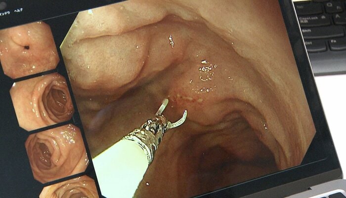 内視鏡でアニサキスを取り除く様子(提供:吉祥寺みどり内科・消化器クリニック