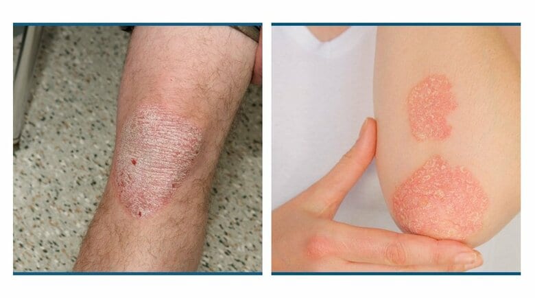 主に肘や膝などの関節付近で確認されることが多い（画像：アムジェン株式会社）