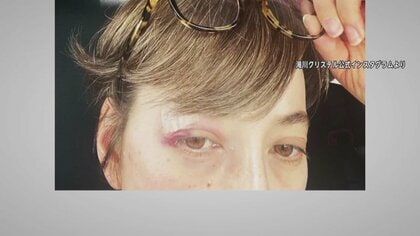 滝川クリステルさん、目元を十数針縫うけが…子ども乗せた電動自転車が転倒で　ヘルメットの着用の大切さ訴え