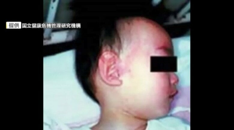 ワクチン接種歴2回あるのに感染か　福岡県内で今年3人目の「はしか」患者　海外渡航歴なしの20代女性｜FNNプライムオンライン