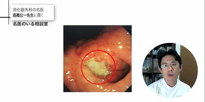 胃潰瘍の9割以上はピロリ菌が原因 春はストレスも加わり増加傾向に…予防と治療法を専門医が解説