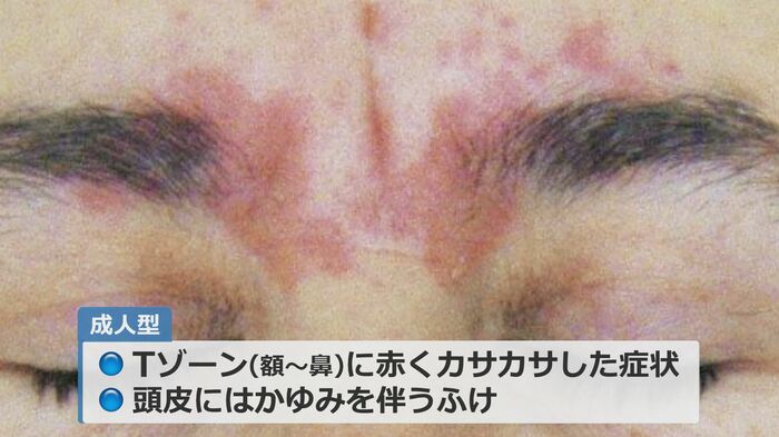 成人型はTゾーンや頭皮に症状が出る