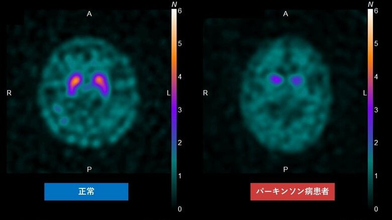 ドパミン産生神経を可視化した画像。正常に産生されている場所が明るく光る