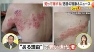 【注意】「痛くて目が覚める」帯状疱疹が20代～40代でも増加中…その要因とは？治療の遅れで神経痛・顔面まひリスクも