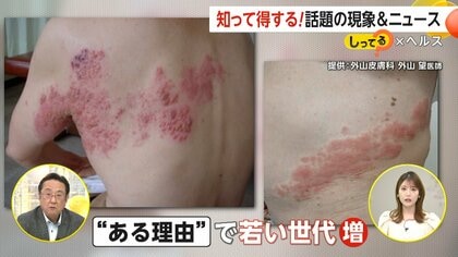 【注意】「痛くて目が覚める」帯状疱疹が20代～40代でも増加中…その要因とは？治療の遅れで神経痛・顔面まひリスクも
