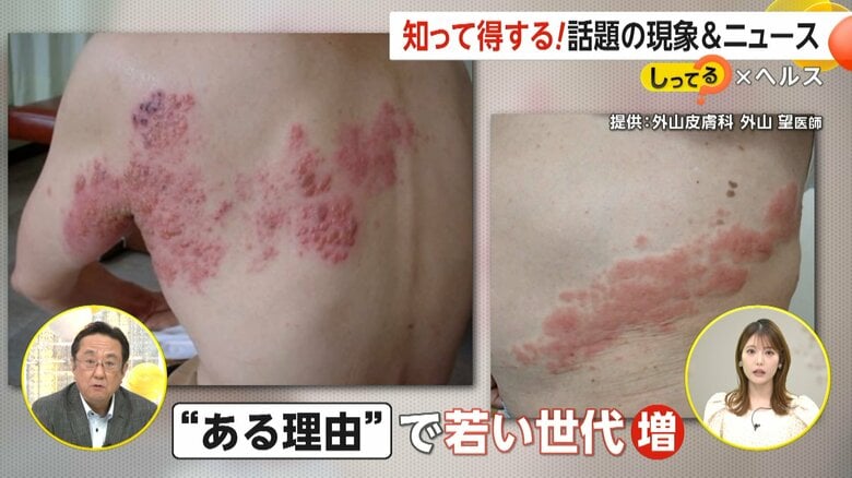 【注意】「痛くて目が覚める」帯状疱疹が20代～40代でも増加中…その要因とは？治療の遅れで神経痛・顔面まひリスクも｜FNNプライムオンライン