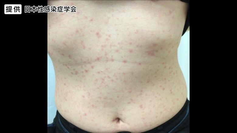 提供：日本性感染症学会