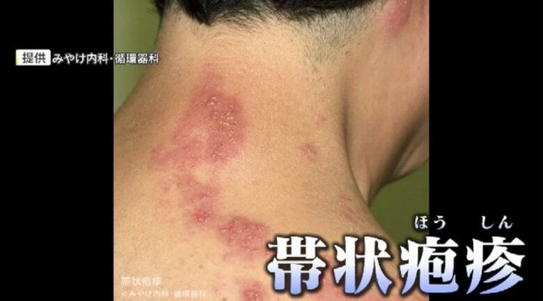 発疹と激しい痛み「帯状疱疹」ワクチンの定期接種スタート　福岡市では任意接種も独自に助成　“80歳までに3人に1人発症”｜FNNプライムオンライン