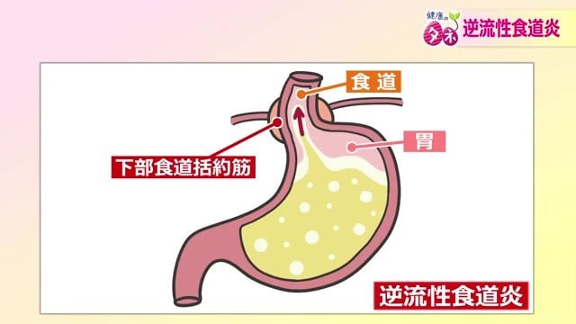 逆流している状態