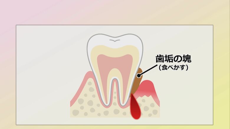 歯周病の発端は食べかす