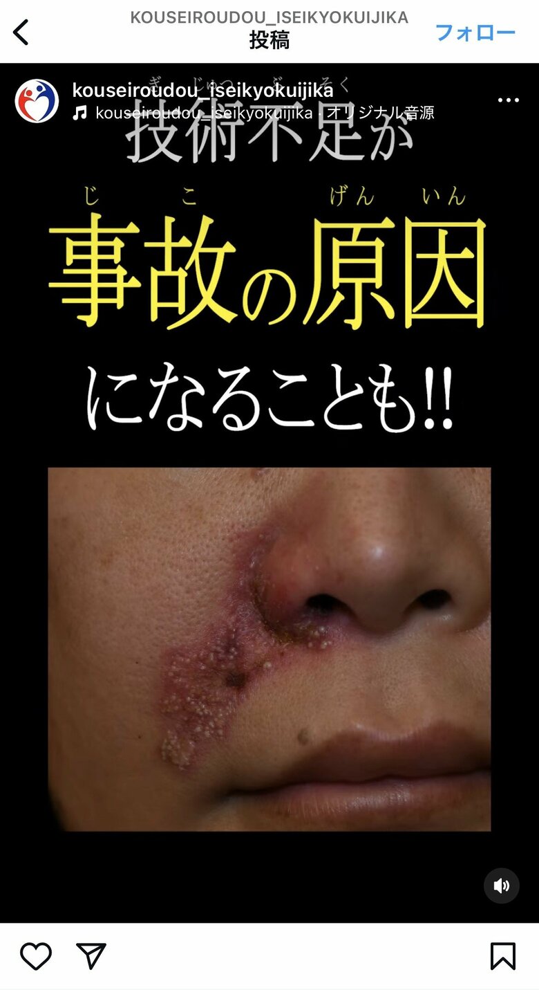 厚労省はインスタでも美容医療の注意喚起