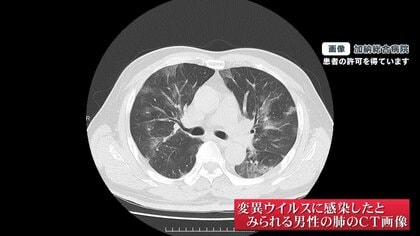 変異ウイルス感染で肺のCTは？ 大阪市の病院で見た治療の最前線
