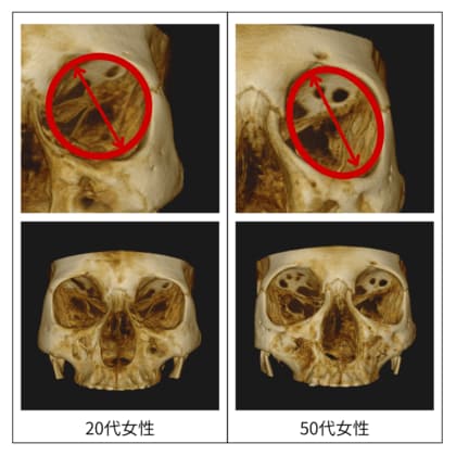 顔のたるみは「肌」ではなく「骨」が原因！？