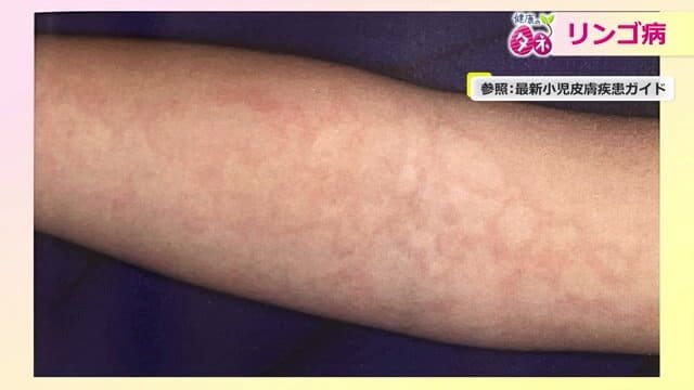 頬の次は手足に網目状の発疹も