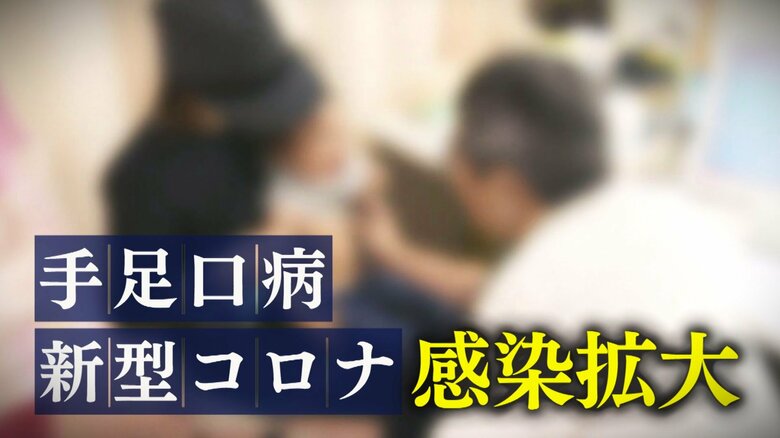 感染拡大傾向の“新型コロナウイルス”と“手足口病”…症状収まっても油断禁物「ウイルス長く体内に」対策徹底を｜FNNプライムオンライン