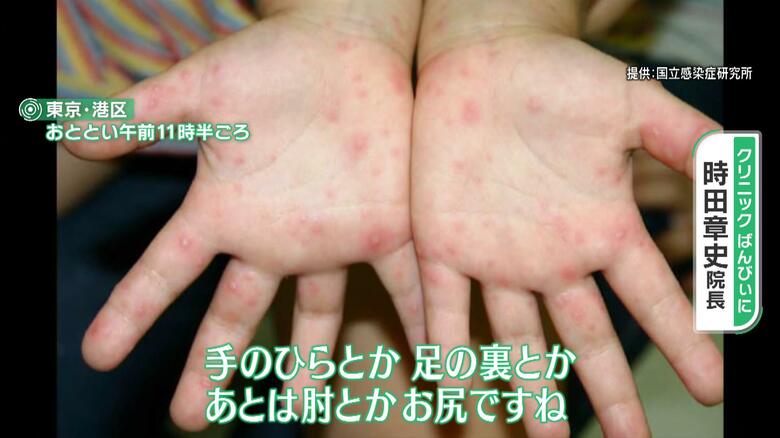 手足口病の発疹