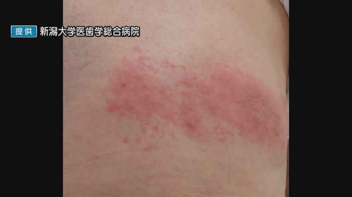 帯状疱疹