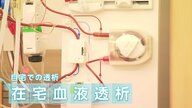 全国普及率1％未満 自宅での人工透析「在宅血液透析」患者の負担軽減や仕事との両立などメリットも課題は病院の負担