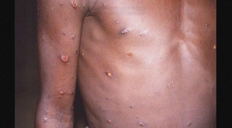 欧米中心に感染が確認されている「サル痘」　特徴や予防法を医師に聞いた