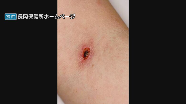 つつが虫に刺された痕