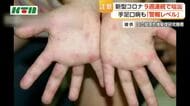 【注意】長崎県内で手足口病警報レベル継続　新型コロナも前週より感染報告数増加
