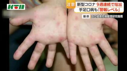 【注意】長崎県内で手足口病警報レベル継続　新型コロナも前週より感染報告数増加