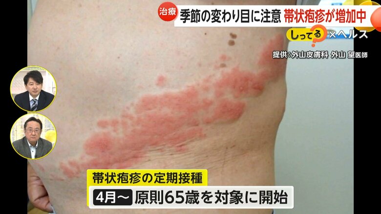 65歳を対象に始まっている帯状疱疹の定期接種
