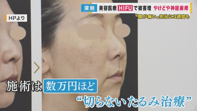 切らないたるみ治療