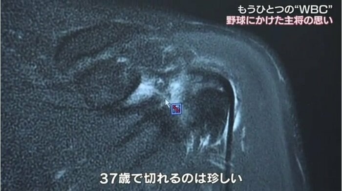 槙原さんの左肩レントゲン写真