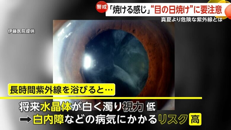 水晶体が白く濁る白内障（映像提供：伊藤医院）