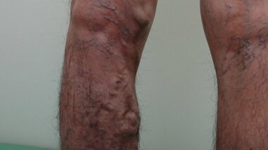 ボコボコの血管、放置すると穴が…7割の人にある「下肢静脈瘤」