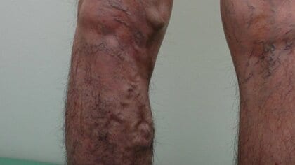 ボコボコの血管、放置すると穴が…7割の人にある「下肢静脈瘤」　接着剤使う画期的治療法も【石川発】
