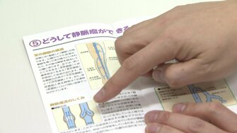 ボコボコの血管 放置すると穴が 7割の人にある 下肢静脈瘤 接着剤 使う画期的治療法も 石川発