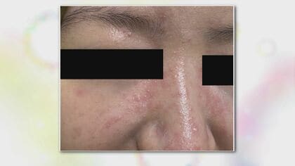 肌が荒れる「花粉皮膚炎」に要注意…14日は4月並みの暖かさ 『花粉と紫外線』のダブルで肌に影響与える恐れ