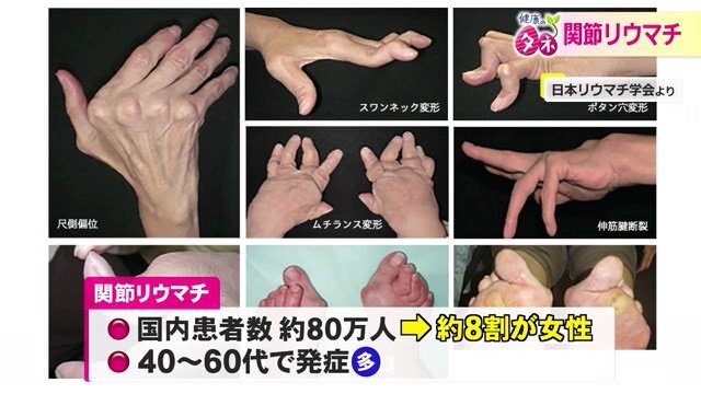関節が破壊され手や足の指が変形する