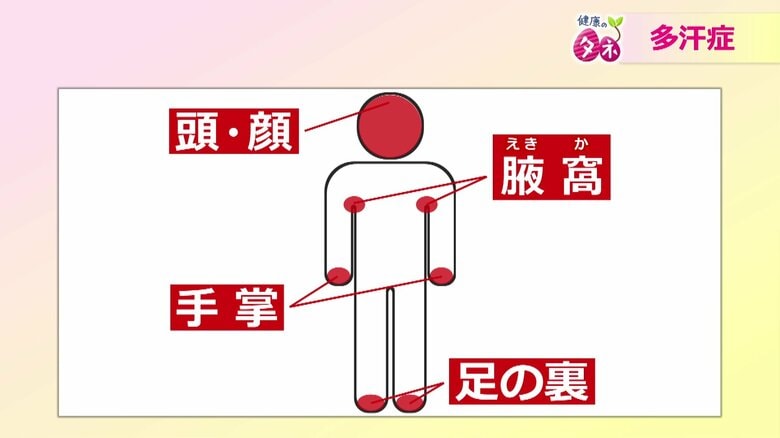 体質と諦めないで！手汗や脇汗で日常生活に支障…それは「原発性局所多汗症」かも　適切な診断と治療でQOL向上を｜FNNプライムオンライン