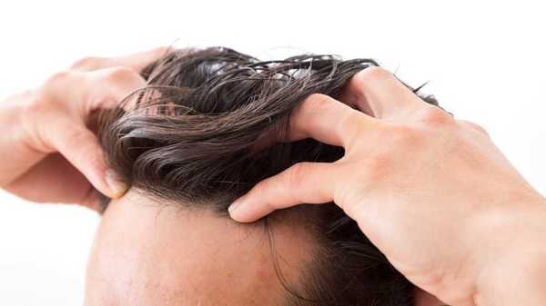 薄毛 コロナ 薄毛だと新型コロナウイルス感染症が重症化しやすいという研究結果