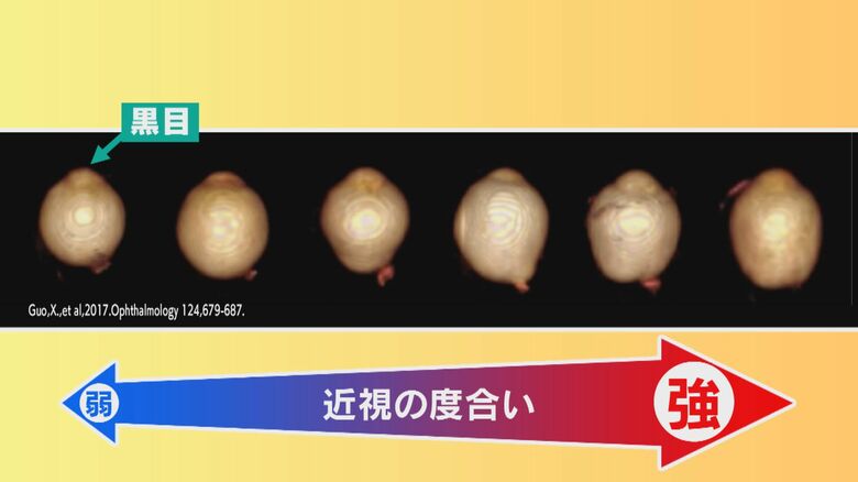 近視のメカニズム