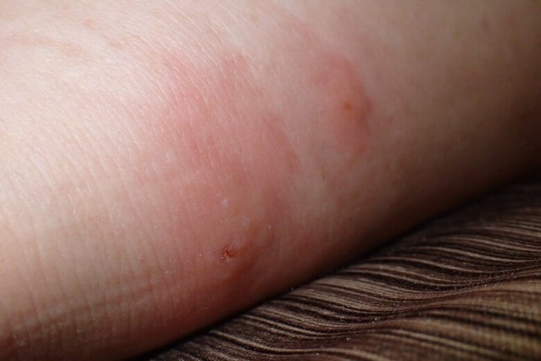 吸血された跡は赤く腫れる（画像提供：西海太介さん）
