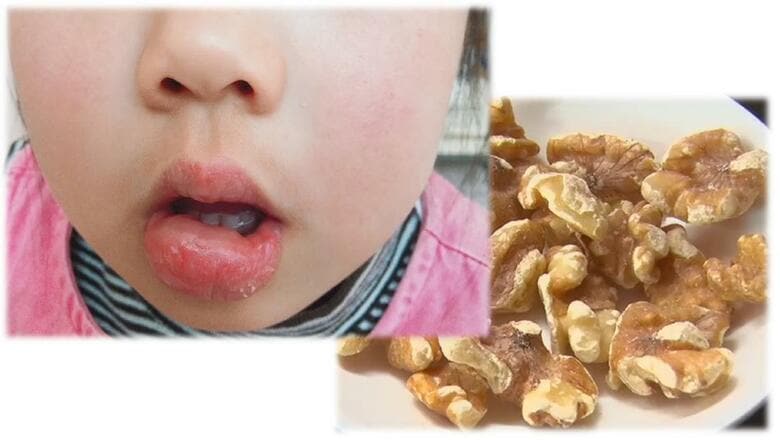 「クルミアレルギー」が10倍に急増　子どもだけでなく大人にも…“健康食品”として大量消費が背景に　｜FNNプライムオンライン