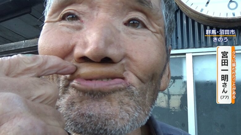 口をかまれ、足の肉を移植したという宮田さん