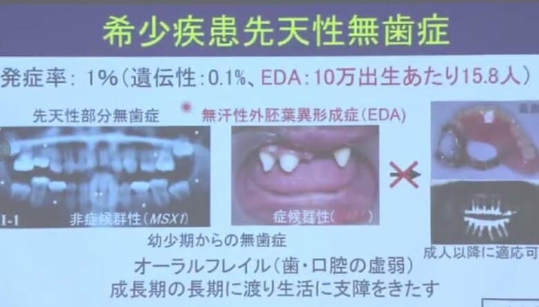 「先天性無歯症」