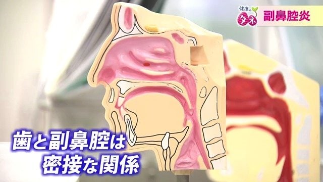虫歯が原因で副鼻腔炎になることも
