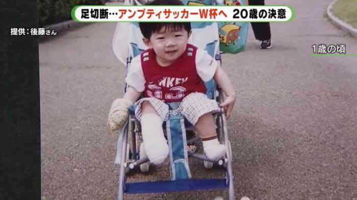 1歳で右足首から下を切断